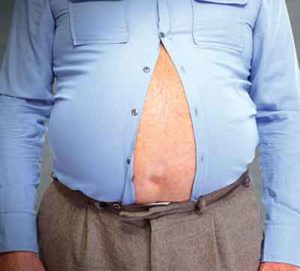 Read more about the article Bariatric Surgery:The Last Hope to Kick Out Stubborn Body Fats