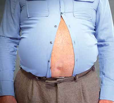 Read more about the article Bariatric Surgery:The Last Hope to Kick Out Stubborn Body Fats